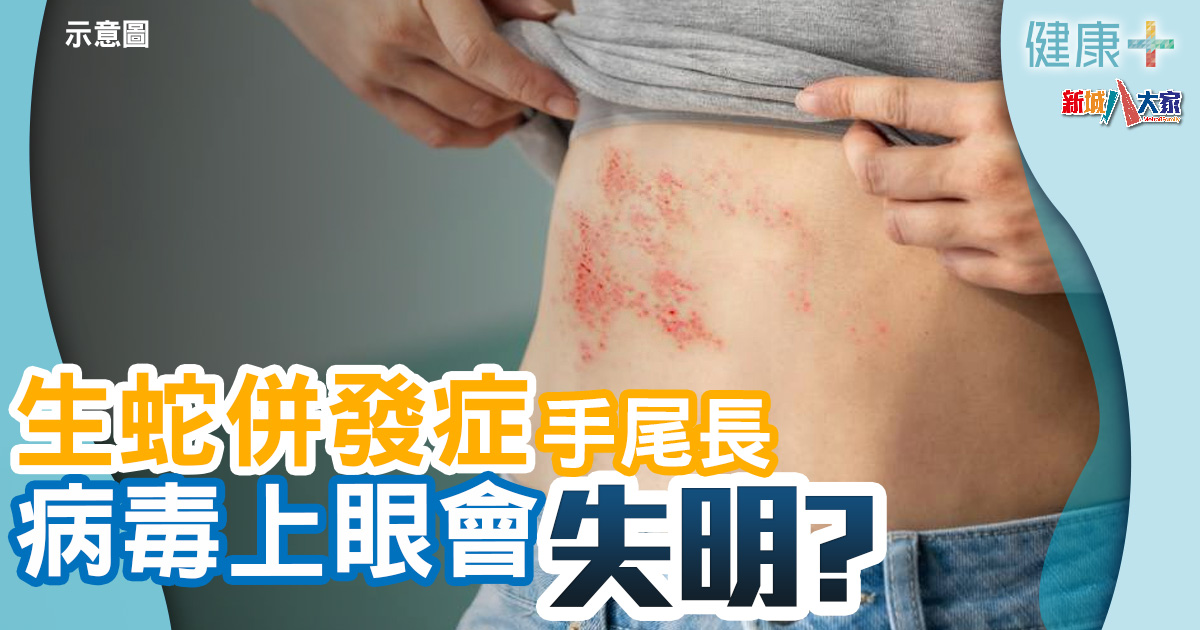 健康-疾病資訊-生蛇風險-帶狀疱疹-併發症