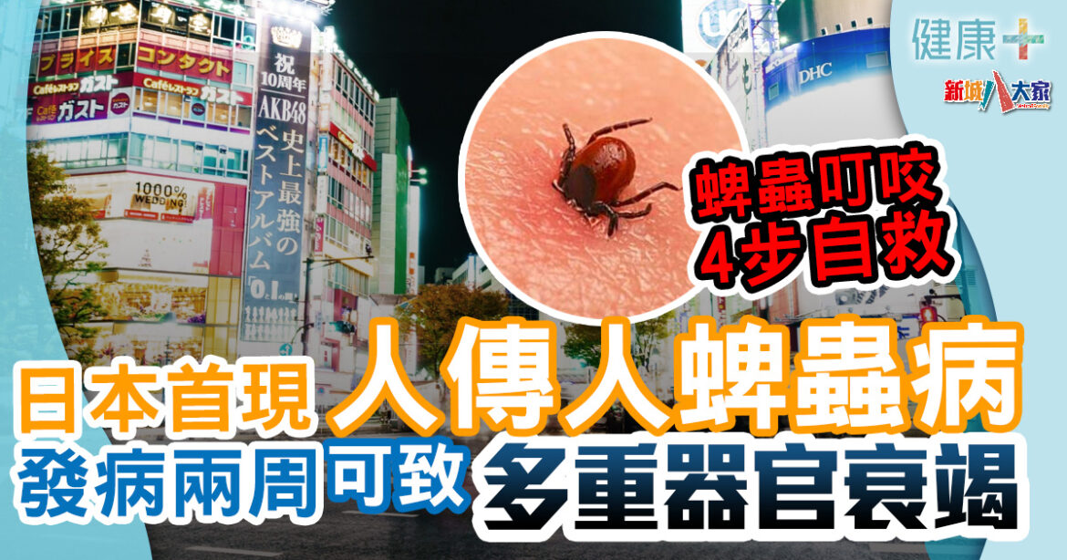 遊日注意｜日本現人傳人蜱蟲病首例　春天小心蜱蟲叮咬4步自救