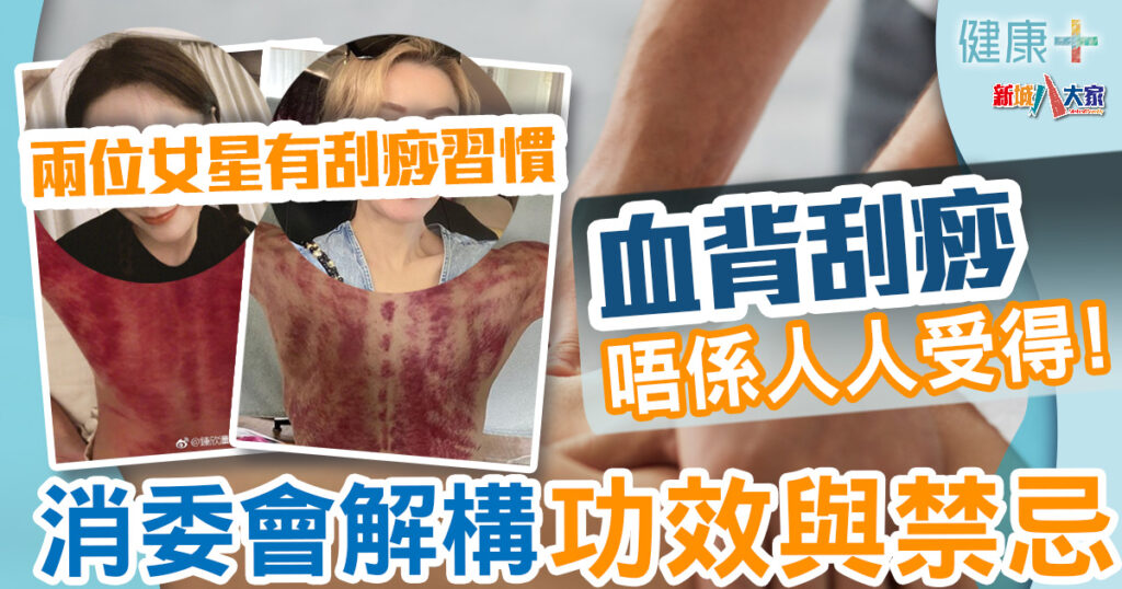 刮痧療法|血背刮痧唔係人人受得 消委會解構功效與禁忌