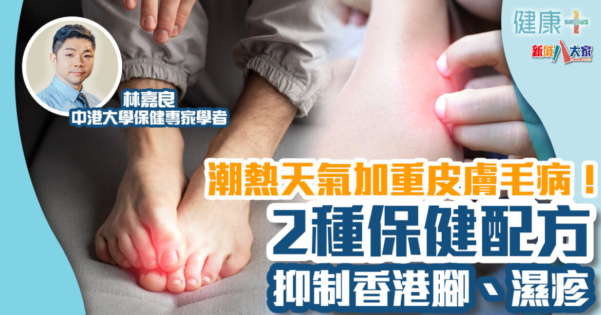 保健專家｜潮熱天氣加重皮膚毛病！2種保健配方抑制香港腳、濕疹