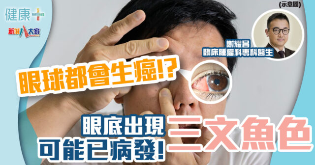 健康-疾病資訊-眼睛健康-眼癌-三文魚色