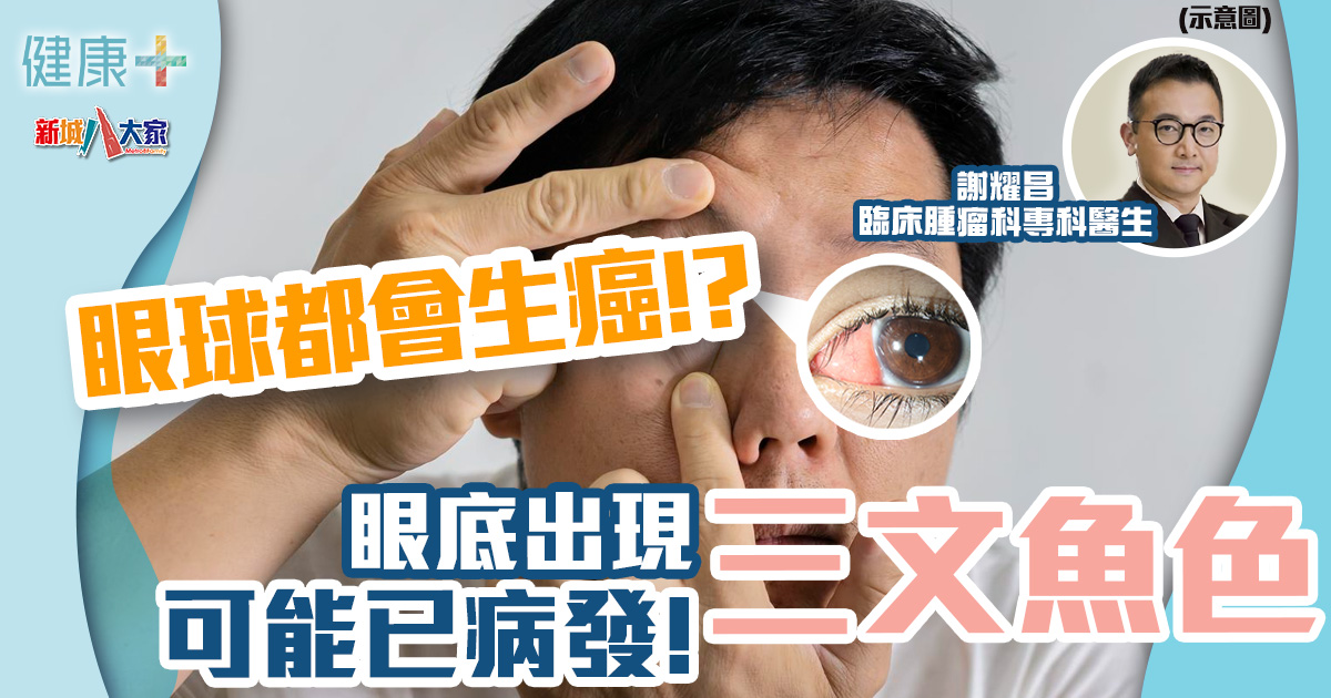眼球都會生癌症!眼球現三文魚色可能已病發!丨臨床腫瘤科謝耀昌醫生 健康-疾病資訊-眼睛健康-眼癌-三文魚色