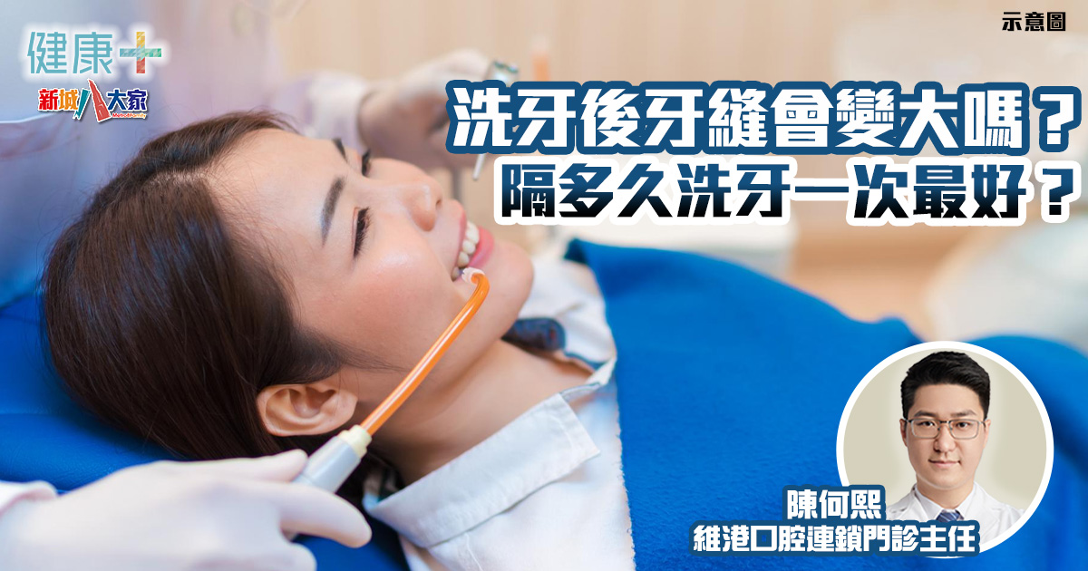 隔多久洗牙一次最好?洗牙後牙縫會變大嗎? 健康-牙科-洗牙-迷思