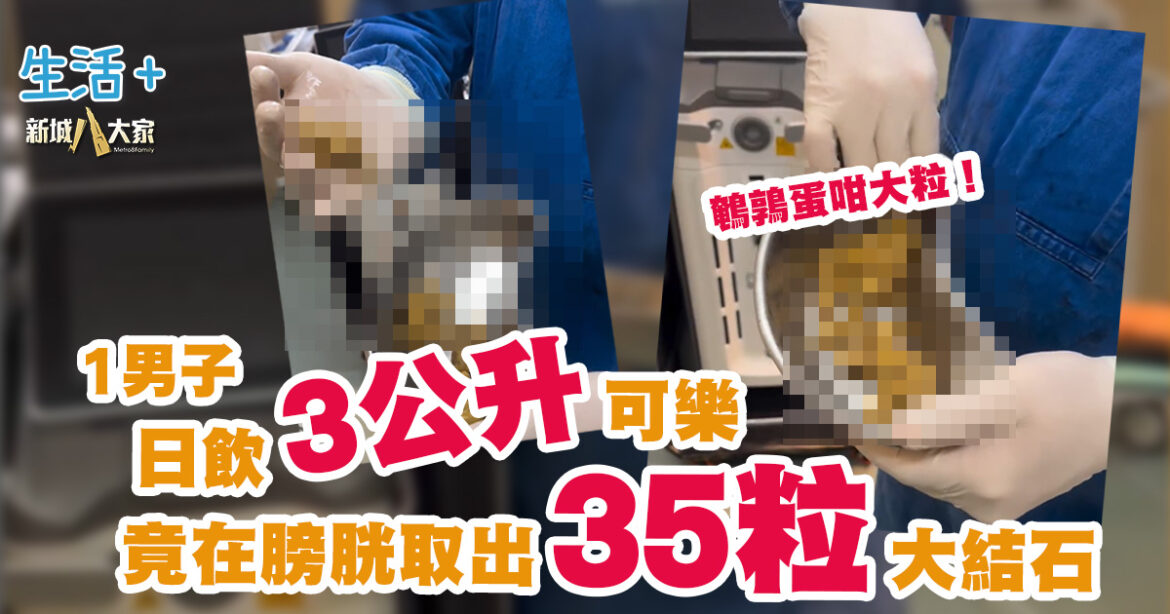1男子日飲3公升可樂 竟在膀胱取出35粒大結石