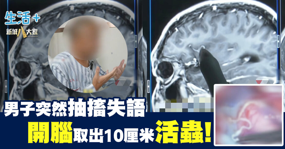 男子突然抽搐失語 開腦取出10厘米活蟲