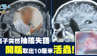 男子突然抽搐失語 開腦取出10厘米活蟲 20250723_37_Og